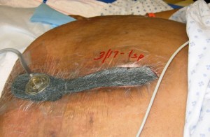 This is what it looks like when it's done. The vac sucks out all the air and excess moisture so the wound stays clean. Photo courtesy of UC Davis Medical Center