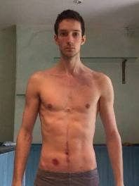 five weeks after second op